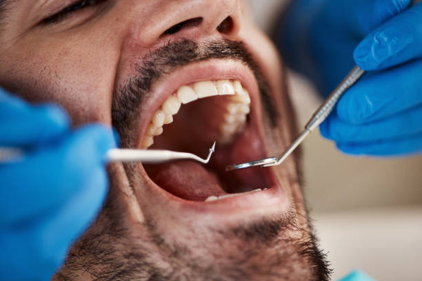 Best Emergency Tooth Extraction in Cleveland, TN